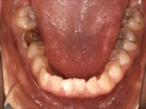 3本以下のう蝕、歯の破折、残根、咬耗